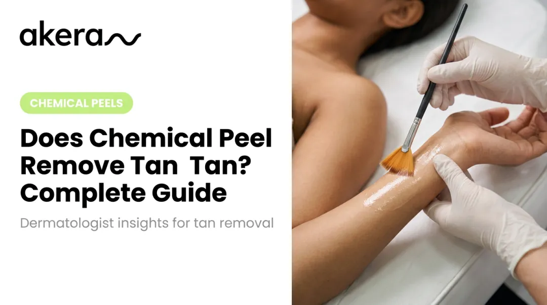 Does Chemical Peel Remove Tan? Complete Guide