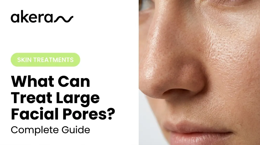 What Can Treat Large Facial Pores? Complete Guide
