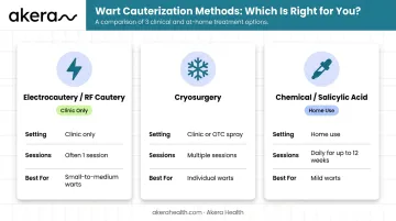 Three wart cauterization methods comparison table infographic with sessions and settings