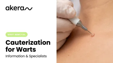 Cauterization for Warts: Information &amp; Specialists