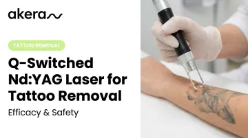 Q-Switched Nd:YAG Laser for Tattoo Removal: Efficacy &amp; Safety