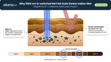 Fitzpatrick skin type IV–V Q-switched 1064nm wavelength safety advantages explained