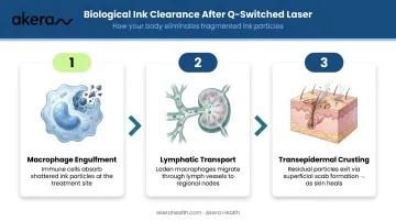3-step tattoo ink clearance process after laser treatment infographic