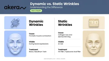 Dynamic versus static forehead wrinkles side-by-side comparison infographic