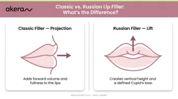 Side profile versus front view lip projection and lift comparison for filler techniques