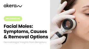 Facial Moles: Symptoms, Causes &amp; Removal Options