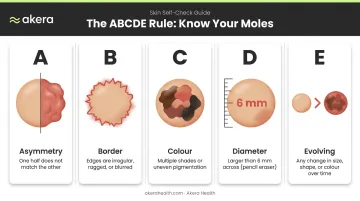 ABCDE rule for mole self-check five warning signs illustrated