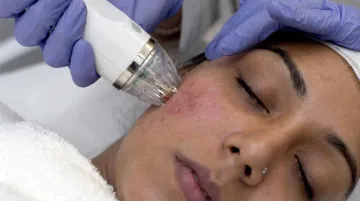 Microneedling RF treatment device applied to diverse skin tones in clinical setting