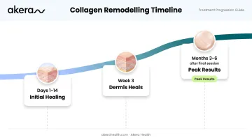 RF microneedling results timeline showing improvement milestones from days to six months post-treatment