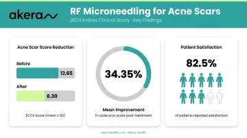 Indian clinical study RF microneedling acne scar improvement statistics and patient satisfaction data