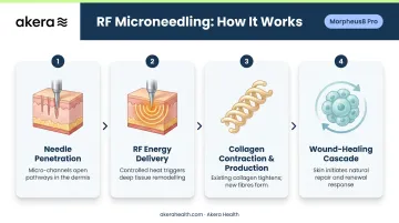 4-step RF microneedling mechanism process from needle penetration to collagen remodelling
