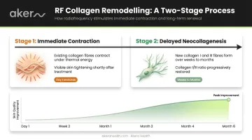RF collagen remodelling two-stage timeline from immediate contraction to neocollagenesis