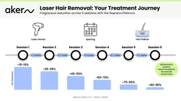 Laser hair removal process timeline showing six sessions spaced over menopausal facial hair treatment
