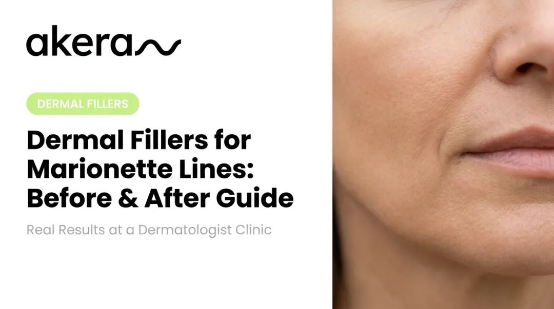 Dermal Fillers for Marionette Lines: Before & After Guide