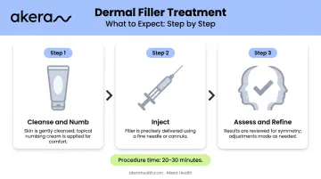 Three-step marionette line filler injection procedure process flow diagram