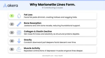 Five causes of marionette lines facial ageing process breakdown infographic