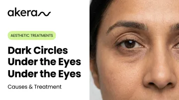 Dark Circles Under the Eyes: Causes & Treatment