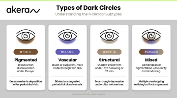 Four clinical types of dark circles comparison chart with appearance and causes