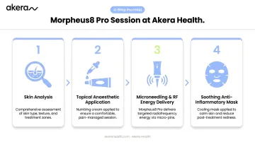 Four-step Morpheus8 Pro RF microneedling treatment protocol process flow