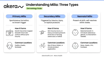 Three types of facial milia comparison chart primary secondary and neonatal