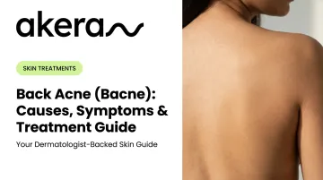 Back Acne (Bacne): Causes, Symptoms &amp; Treatment Guide
