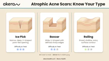 Three atrophic acne scar types ice pick boxcar rolling comparison infographic