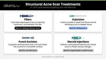 Four structural acne scar treatments fillers subcision punch excision steroid injections overview