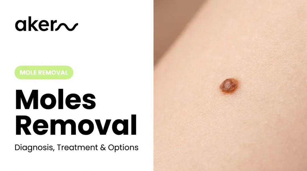 Moles Removal: Diagnosis, Treatment & Options