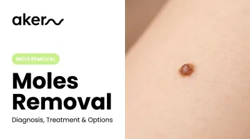 Moles Removal: Diagnosis, Treatment & Options