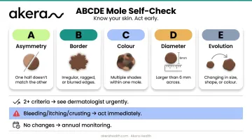 ABCDE mole self-check method five-criteria assessment guide infographic