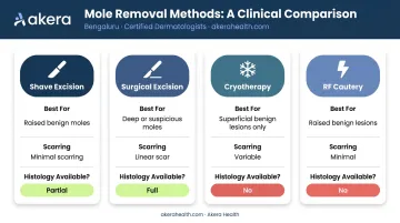 Four professional mole removal methods comparison chart shave excision to cryotherapy