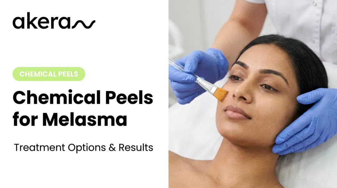 Chemical Peels for Melasma: Treatment Options & Results