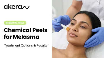 Chemical Peels for Melasma: Treatment Options & Results
