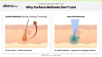 Surface hair removal versus laser follicle targeting method comparison infographic