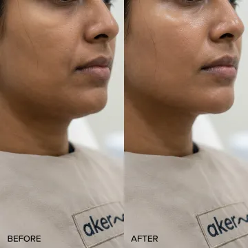 Dermal filler before and after results