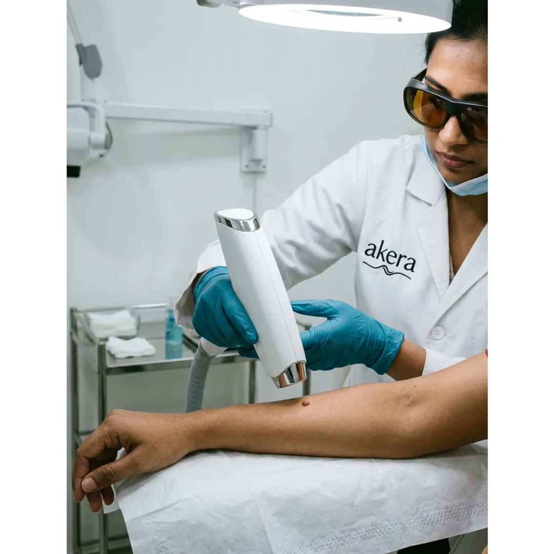 Laser Mole Removal Treatment Services
