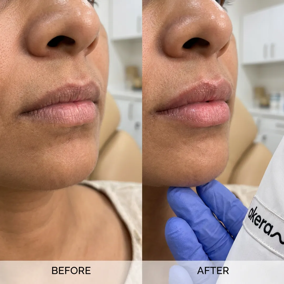 Lip Fillers for Thin Lips — Before & After Results