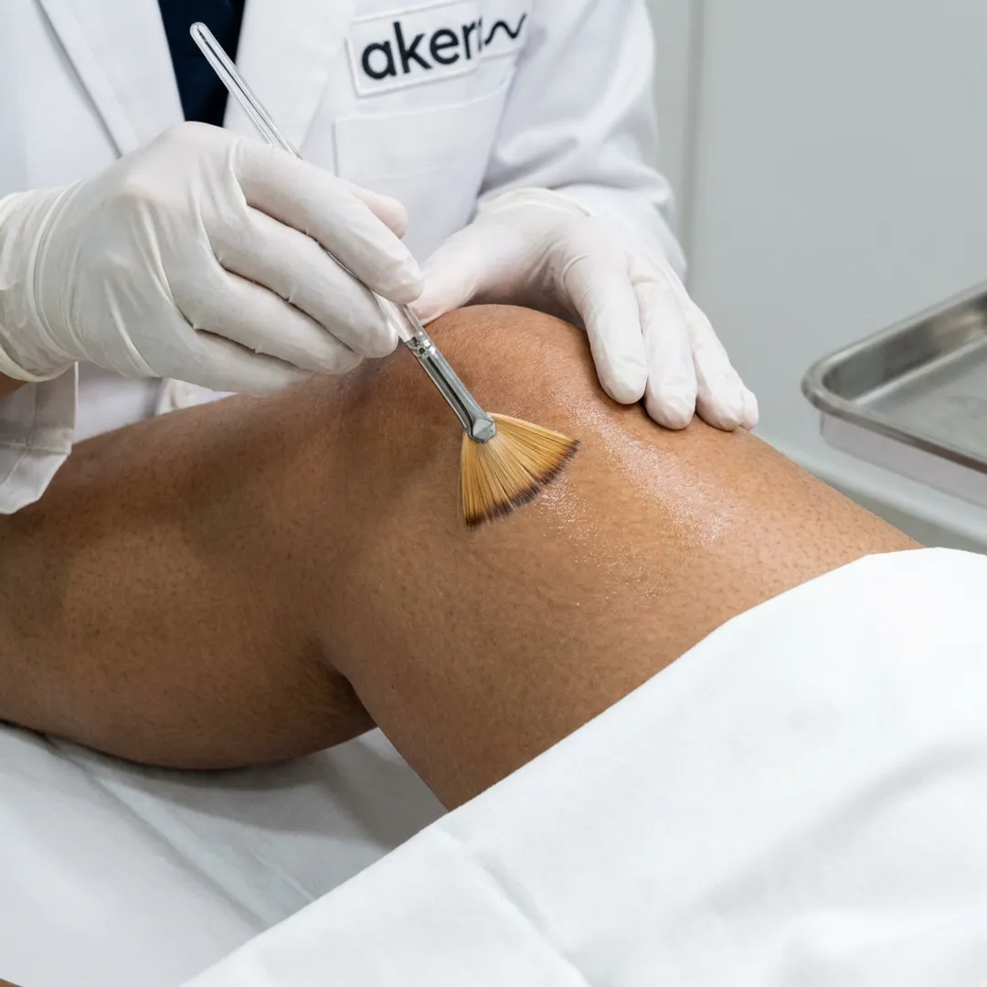 Chemical Peels for Knees, Elbows & Feet