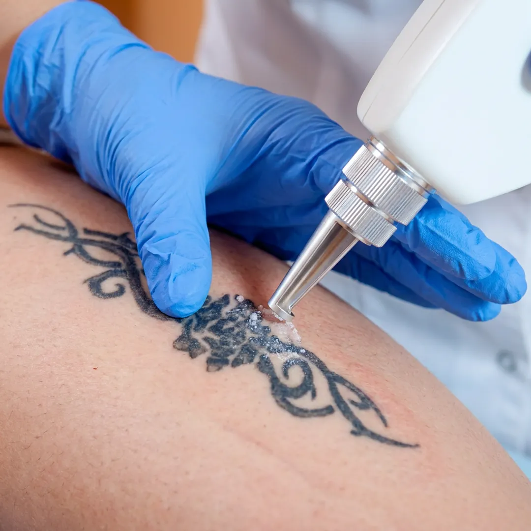 Tattoo Removal — Q-Switch Laser Treatment Services