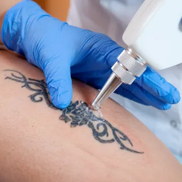 Q-Switch laser tattoo removal treatment