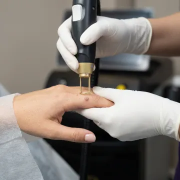 Dermatologist performing wart removal procedure