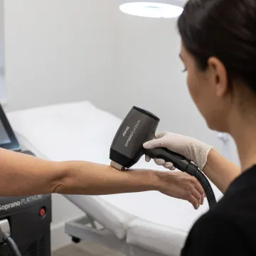 Soprano Platinum laser hair removal treatment