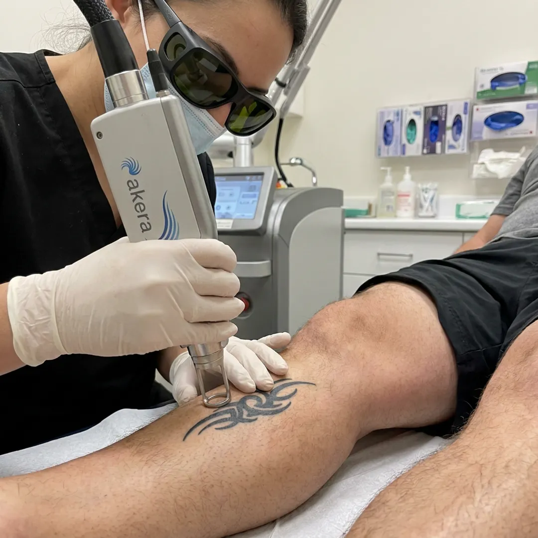 Pico Laser Tattoo Removal Cost