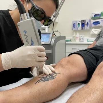 Pico Laser Tattoo Removal Cost