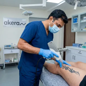 Laser Tattoo Removal Cost in Bangalore