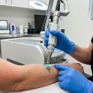 Laser Tattoo Removal Cost