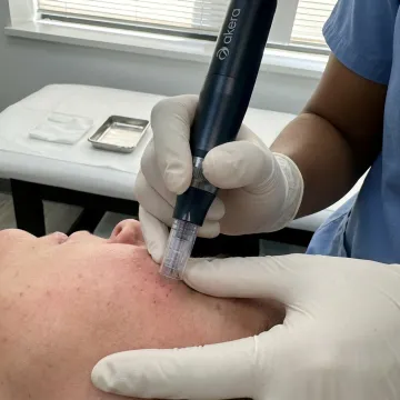 Dermapen Microneedling Treatment