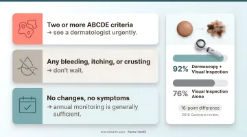 ABCDE mole self-check method five-criteria assessment guide infographic