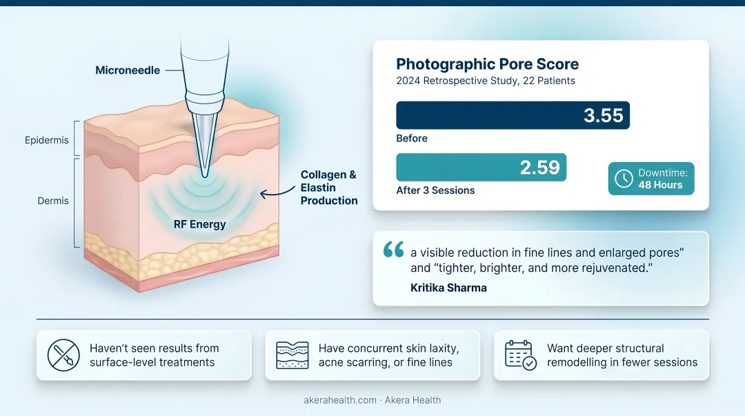 Morpheus8 Pro RF microneedling treatment being performed in dermatology clinic