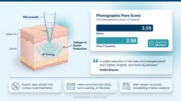 Morpheus8 Pro RF microneedling treatment being performed in dermatology clinic
